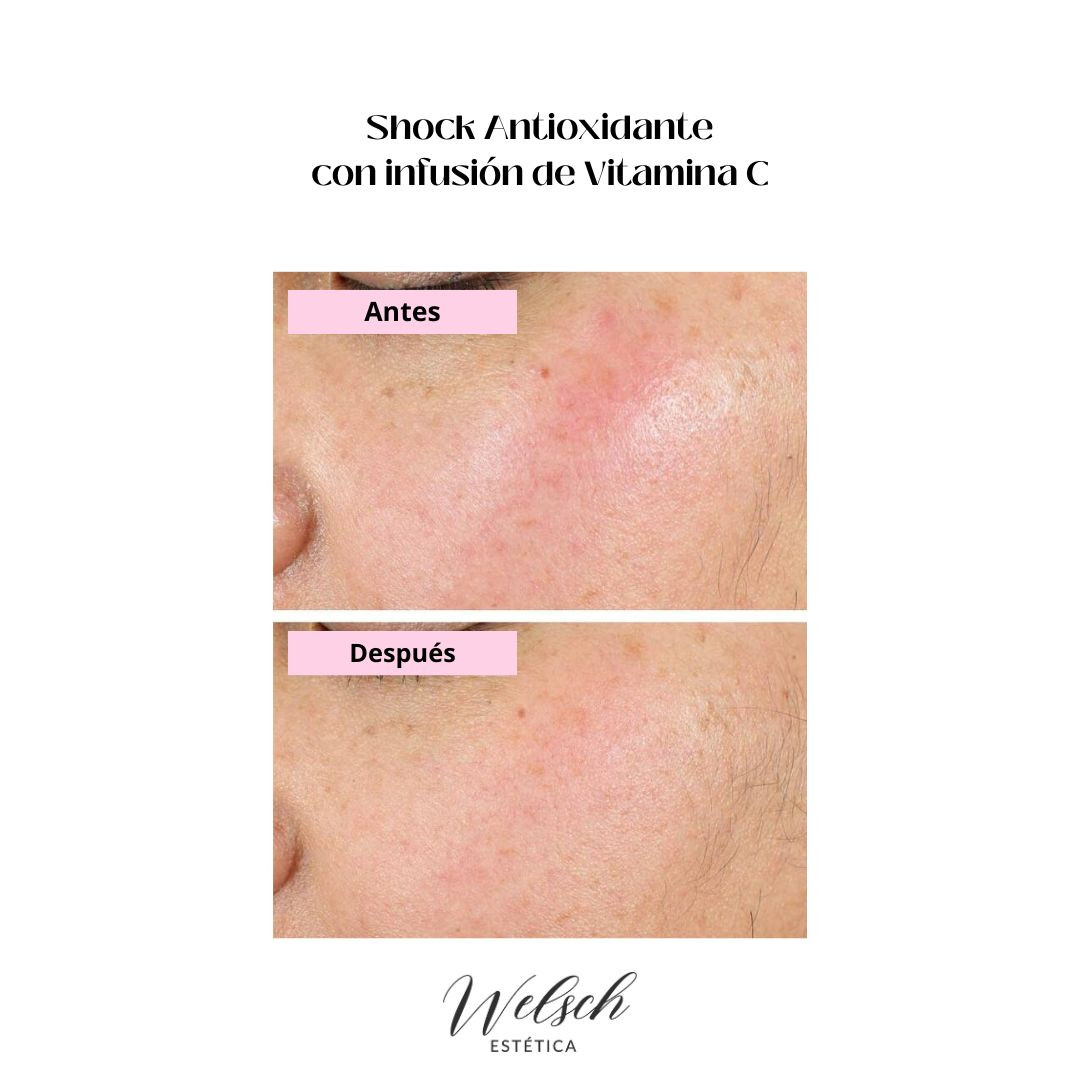 Welsch Estetica Tratamiento-Rejuvenecedor-con-formula-exclusiva-Peeling-de-Retinol-doble-fase-y-mascara-de-fitoestrogenos-2  